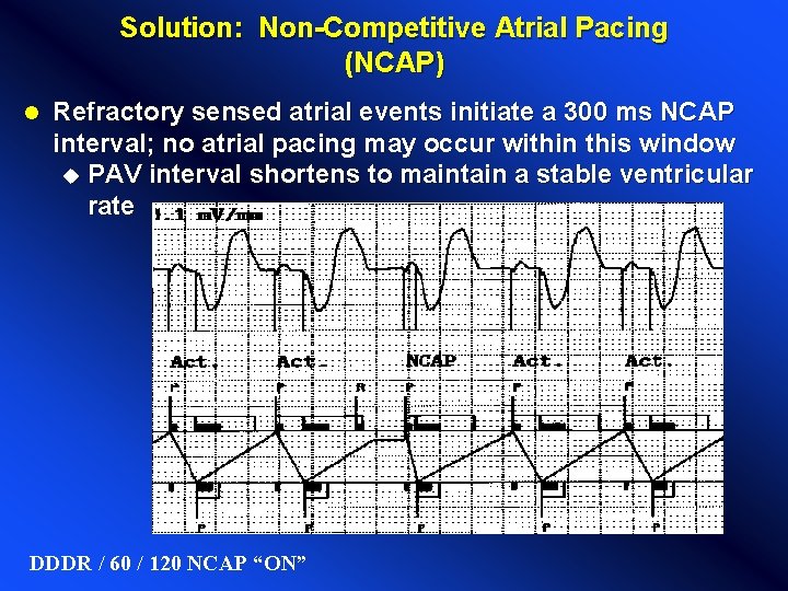 Solution: Non-Competitive Atrial Pacing (NCAP) l Refractory sensed atrial events initiate a 300 ms