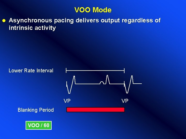 VOO Mode l Asynchronous pacing delivers output regardless of intrinsic activity Lower Rate Interval