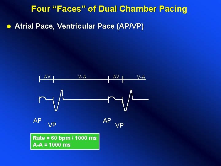 Four “Faces” of Dual Chamber Pacing l Atrial Pace, Ventricular Pace (AP/VP) AV AP Four “Faces” of Dual Chamber Pacing l Atrial Pace, Ventricular Pace (AP/VP) AV AP