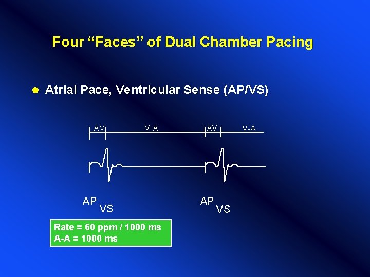 Four “Faces” of Dual Chamber Pacing l Atrial Pace, Ventricular Sense (AP/VS) AV AP