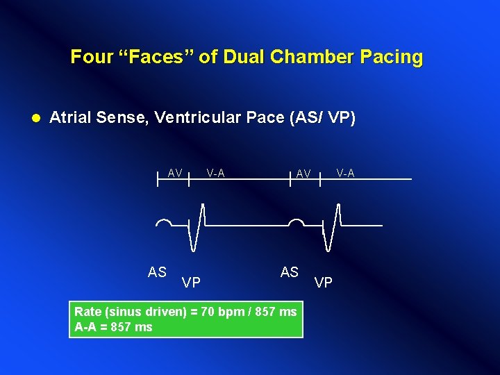 Four “Faces” of Dual Chamber Pacing l Atrial Sense, Ventricular Pace (AS/ VP) AV Four “Faces” of Dual Chamber Pacing l Atrial Sense, Ventricular Pace (AS/ VP) AV