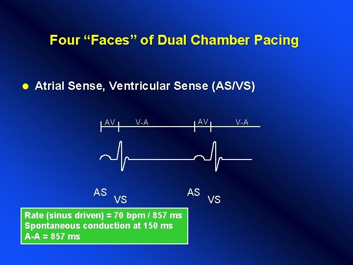 Four “Faces” of Dual Chamber Pacing l Atrial Sense, Ventricular Sense (AS/VS) AV AS Four “Faces” of Dual Chamber Pacing l Atrial Sense, Ventricular Sense (AS/VS) AV AS