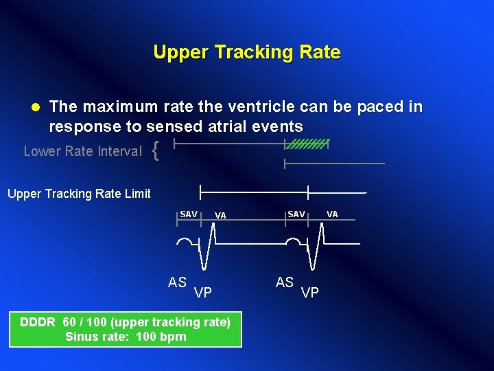 Upper Tracking Rate l The maximum rate the ventricle can be paced in response