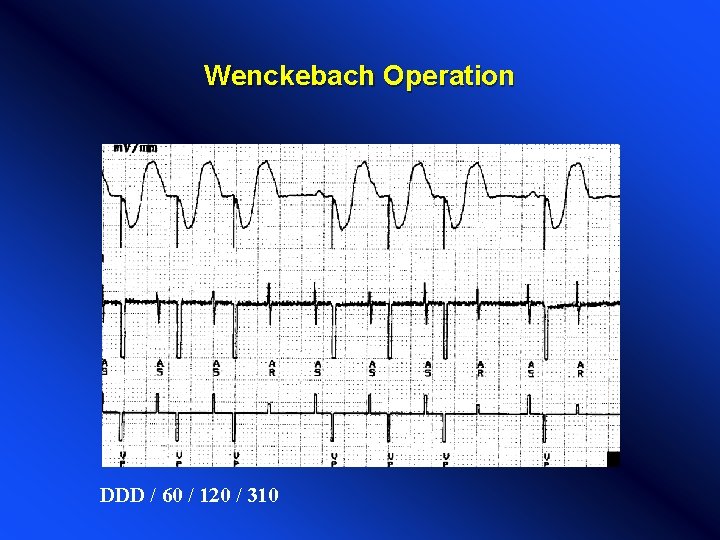 Wenckebach Operation DDD / 60 / 120 / 310 Wenckebach Operation DDD / 60 / 120 / 310
