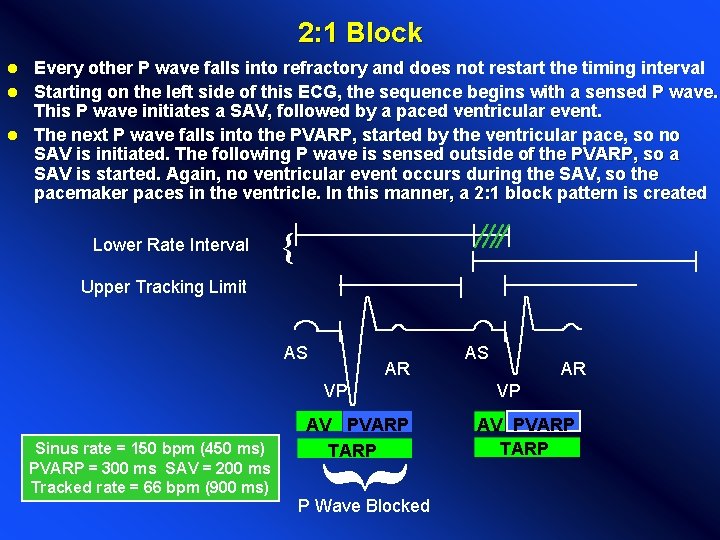 2: 1 Block Every other P wave falls into refractory and does not restart 2: 1 Block Every other P wave falls into refractory and does not restart