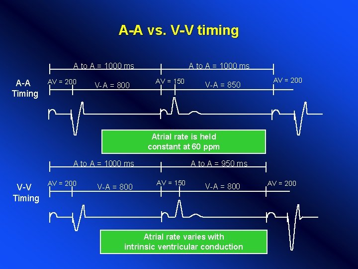 A-A vs. V-V timing A to A = 1000 ms A-A Timing AV =