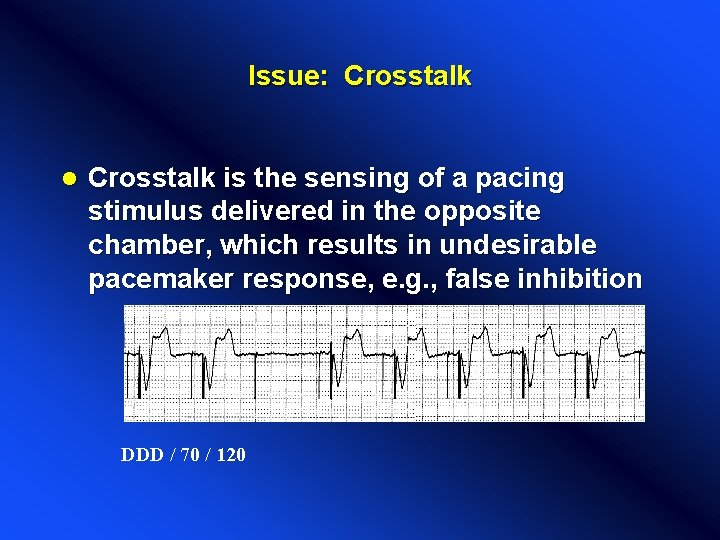 Issue: Crosstalk l Crosstalk is the sensing of a pacing stimulus delivered in the Issue: Crosstalk l Crosstalk is the sensing of a pacing stimulus delivered in the
