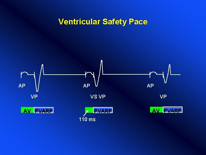 Ventricular Safety Pace AP AP VP AV PVARP AP VS VP PVARP 110 ms Ventricular Safety Pace AP AP VP AV PVARP AP VS VP PVARP 110 ms