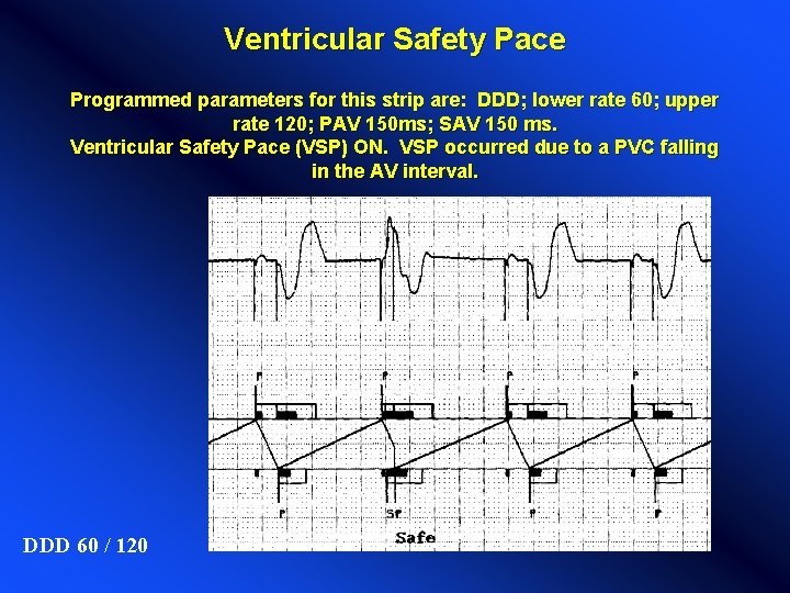 Ventricular Safety Pace Programmed parameters for this strip are: DDD; lower rate 60; upper Ventricular Safety Pace Programmed parameters for this strip are: DDD; lower rate 60; upper