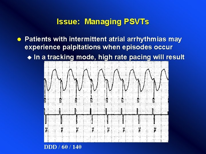 Issue: Managing PSVTs l Patients with intermittent atrial arrhythmias may experience palpitations when episodes Issue: Managing PSVTs l Patients with intermittent atrial arrhythmias may experience palpitations when episodes