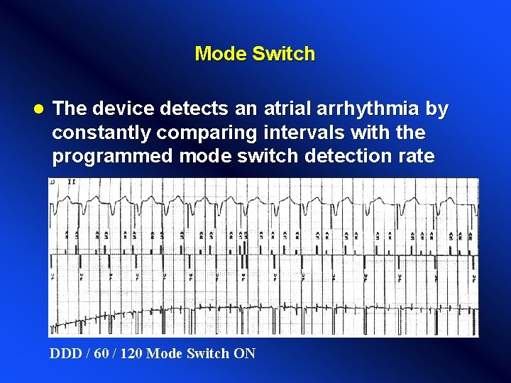 Mode Switch l The device detects an atrial arrhythmia by constantly comparing intervals with Mode Switch l The device detects an atrial arrhythmia by constantly comparing intervals with