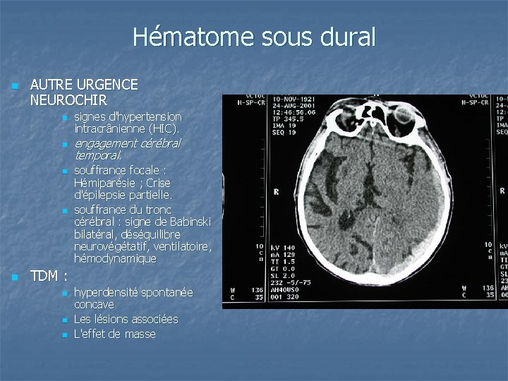 Hématome sous dural n AUTRE URGENCE NEUROCHIR n n n signes d'hypertension intracrânienne (HIC).