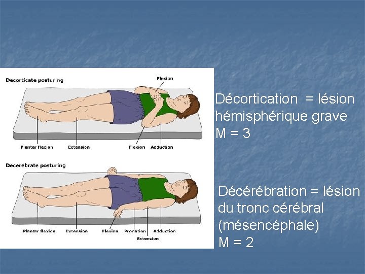 Décortication = lésion hémisphérique grave M=3 Décérébration = lésion du tronc cérébral (mésencéphale) M=2