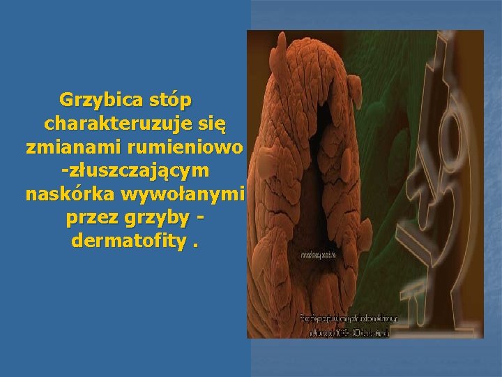 Grzybica stóp charakteruzuje się zmianami rumieniowo -złuszczającym naskórka wywołanymi przez grzyby dermatofity. 