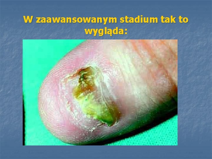 W zaawansowanym stadium tak to wygląda: 