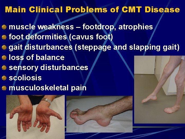 Main Clinical Problems of CMT Disease muscle weakness – footdrop, atrophies foot deformities (cavus