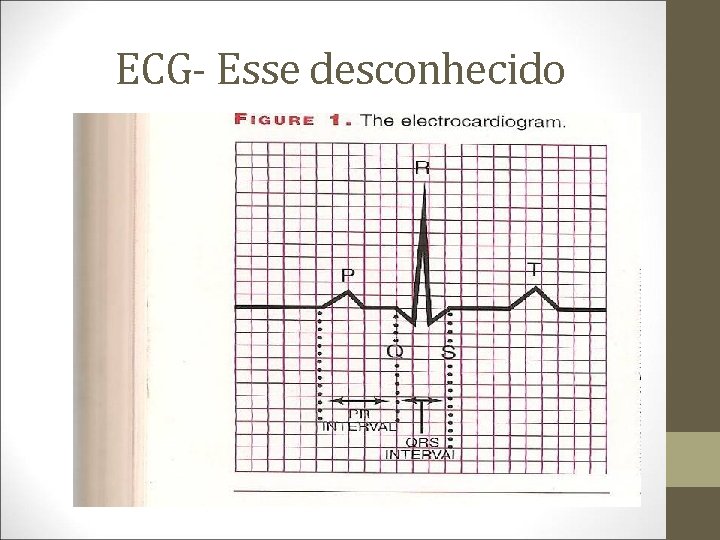 ECG- Esse desconhecido 