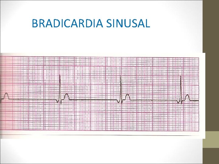 BRADICARDIA SINUSAL 