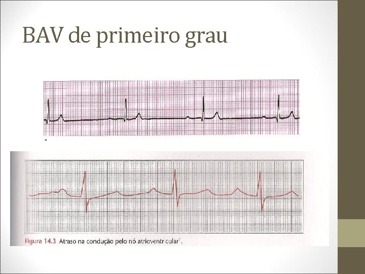 BAV de primeiro grau 