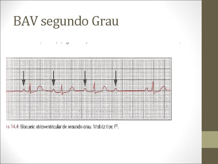 BAV segundo Grau 