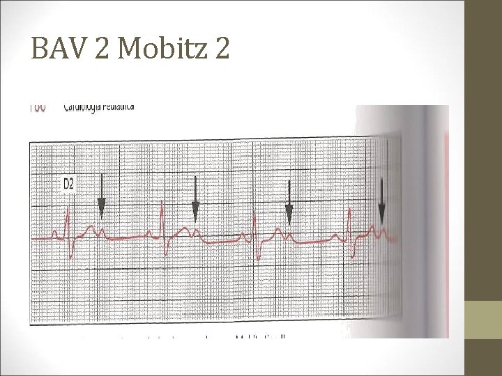 BAV 2 Mobitz 2 