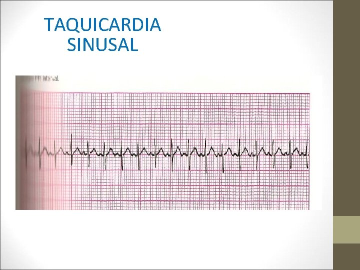 TAQUICARDIA SINUSAL 