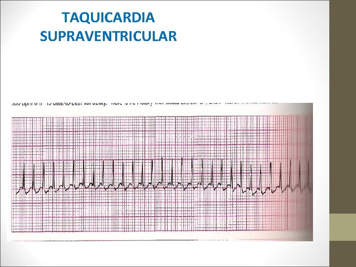 TAQUICARDIA SUPRAVENTRICULAR 