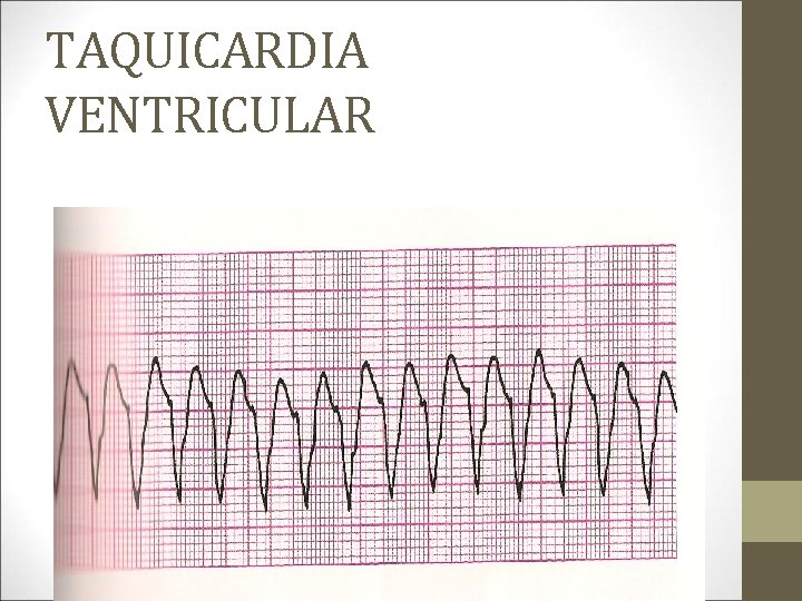 TAQUICARDIA VENTRICULAR 