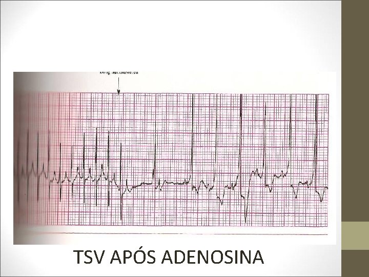 TSV APÓS ADENOSINA 