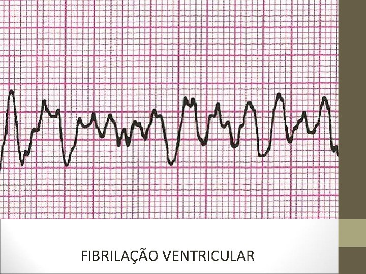 FIBRILAÇÃO VENTRICULAR 