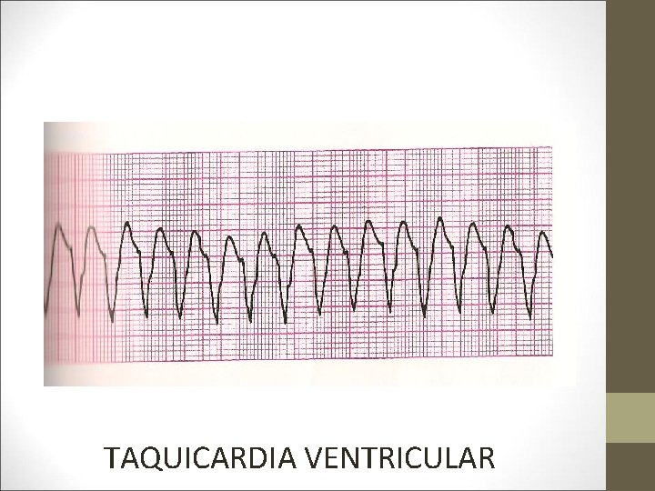 TAQUICARDIA VENTRICULAR 