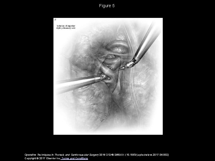 Figure 5 Operative Techniques in Thoracic and Cardiovascular Surgery 2016 21249 -268 DOI: (10. Figure 5 Operative Techniques in Thoracic and Cardiovascular Surgery 2016 21249 -268 DOI: (10.