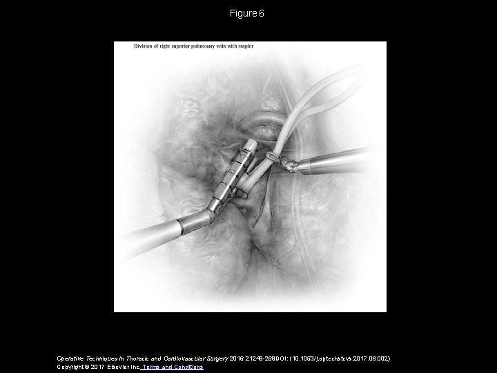 Figure 6 Operative Techniques in Thoracic and Cardiovascular Surgery 2016 21249 -268 DOI: (10. 1053/j. Figure 6 Operative Techniques in Thoracic and Cardiovascular Surgery 2016 21249 -268 DOI: (10. 1053/j.
