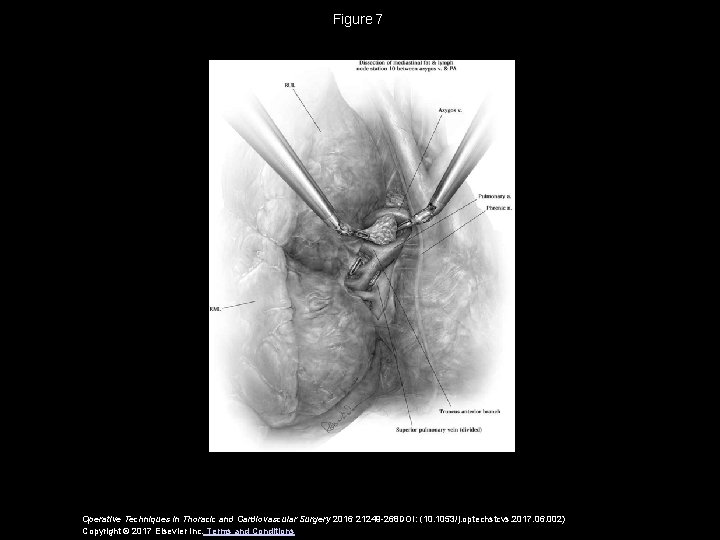Figure 7 Operative Techniques in Thoracic and Cardiovascular Surgery 2016 21249 -268 DOI: (10. 1053/j. Figure 7 Operative Techniques in Thoracic and Cardiovascular Surgery 2016 21249 -268 DOI: (10. 1053/j.