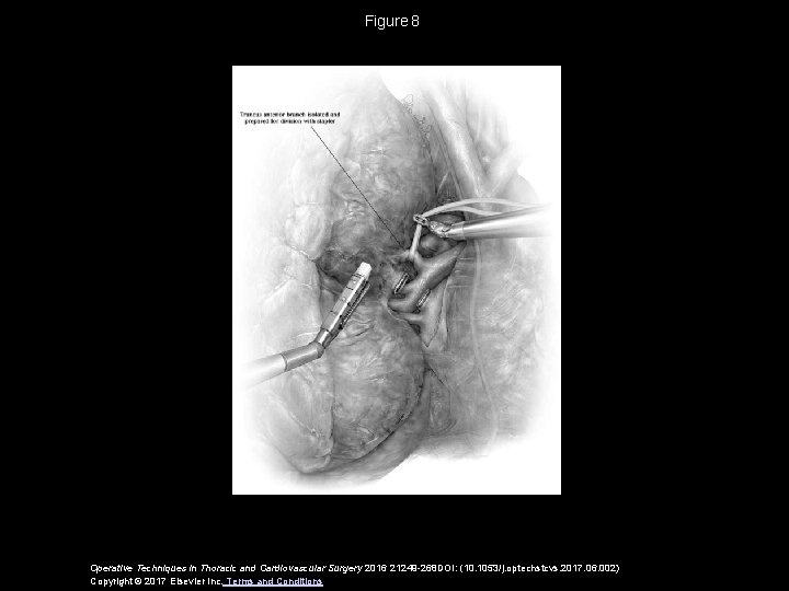 Figure 8 Operative Techniques in Thoracic and Cardiovascular Surgery 2016 21249 -268 DOI: (10. 1053/j. Figure 8 Operative Techniques in Thoracic and Cardiovascular Surgery 2016 21249 -268 DOI: (10. 1053/j.