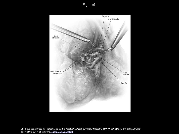 Figure 9 Operative Techniques in Thoracic and Cardiovascular Surgery 2016 21249 -268 DOI: (10. 1053/j. Figure 9 Operative Techniques in Thoracic and Cardiovascular Surgery 2016 21249 -268 DOI: (10. 1053/j.