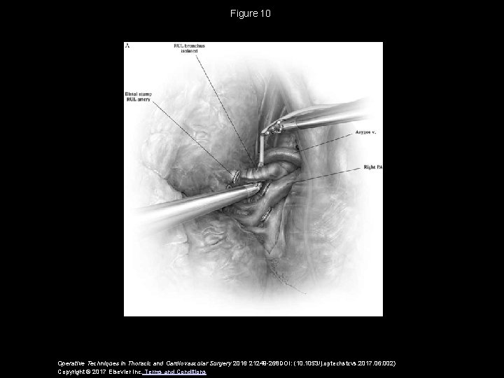 Figure 10 Operative Techniques in Thoracic and Cardiovascular Surgery 2016 21249 -268 DOI: (10. 1053/j. Figure 10 Operative Techniques in Thoracic and Cardiovascular Surgery 2016 21249 -268 DOI: (10. 1053/j.