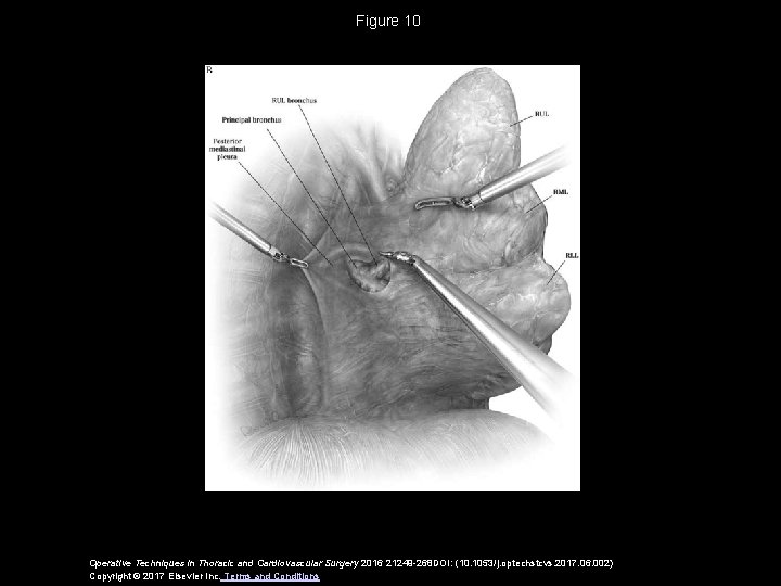 Figure 10 Operative Techniques in Thoracic and Cardiovascular Surgery 2016 21249 -268 DOI: (10. Figure 10 Operative Techniques in Thoracic and Cardiovascular Surgery 2016 21249 -268 DOI: (10.