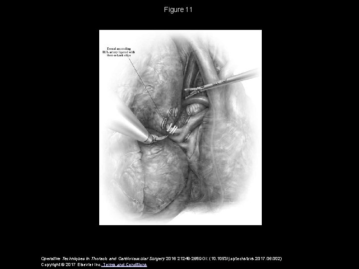 Figure 11 Operative Techniques in Thoracic and Cardiovascular Surgery 2016 21249 -268 DOI: (10. 1053/j. Figure 11 Operative Techniques in Thoracic and Cardiovascular Surgery 2016 21249 -268 DOI: (10. 1053/j.