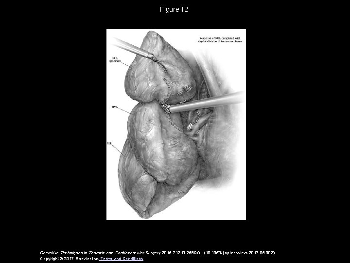 Figure 12 Operative Techniques in Thoracic and Cardiovascular Surgery 2016 21249 -268 DOI: (10. 1053/j. Figure 12 Operative Techniques in Thoracic and Cardiovascular Surgery 2016 21249 -268 DOI: (10. 1053/j.