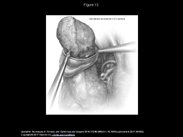 Figure 13 Operative Techniques in Thoracic and Cardiovascular Surgery 2016 21249 -268 DOI: (10. 1053/j. Figure 13 Operative Techniques in Thoracic and Cardiovascular Surgery 2016 21249 -268 DOI: (10. 1053/j.
