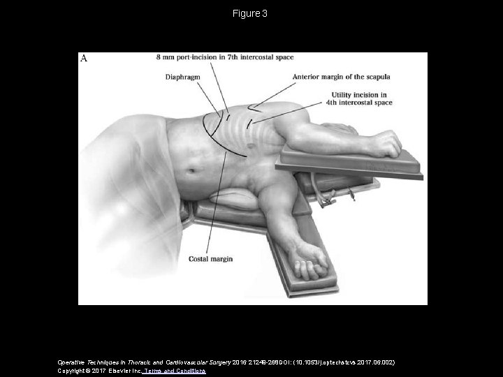 Figure 3 Operative Techniques in Thoracic and Cardiovascular Surgery 2016 21249 -268 DOI: (10. 1053/j. Figure 3 Operative Techniques in Thoracic and Cardiovascular Surgery 2016 21249 -268 DOI: (10. 1053/j.