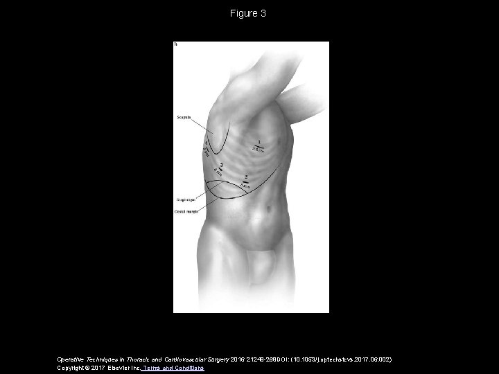 Figure 3 Operative Techniques in Thoracic and Cardiovascular Surgery 2016 21249 -268 DOI: (10. Figure 3 Operative Techniques in Thoracic and Cardiovascular Surgery 2016 21249 -268 DOI: (10.