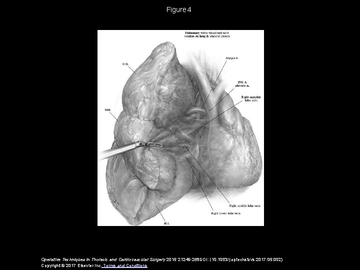 Figure 4 Operative Techniques in Thoracic and Cardiovascular Surgery 2016 21249 -268 DOI: (10. 1053/j. Figure 4 Operative Techniques in Thoracic and Cardiovascular Surgery 2016 21249 -268 DOI: (10. 1053/j.
