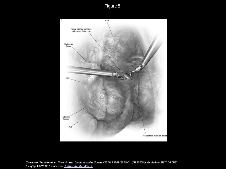 Figure 5 Operative Techniques in Thoracic and Cardiovascular Surgery 2016 21249 -268 DOI: (10. 1053/j. Figure 5 Operative Techniques in Thoracic and Cardiovascular Surgery 2016 21249 -268 DOI: (10. 1053/j.