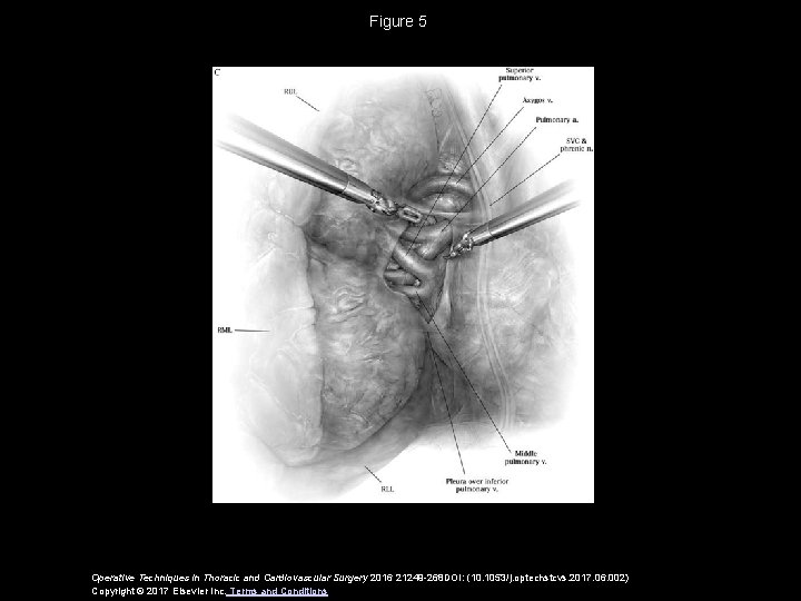 Figure 5 Operative Techniques in Thoracic and Cardiovascular Surgery 2016 21249 -268 DOI: (10. Figure 5 Operative Techniques in Thoracic and Cardiovascular Surgery 2016 21249 -268 DOI: (10.
