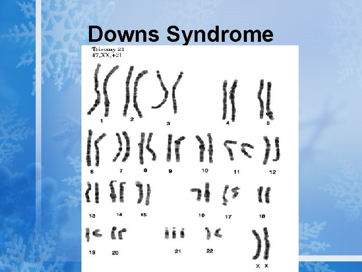 Downs Syndrome 