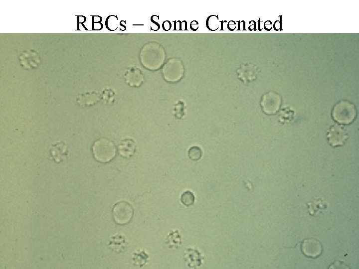 RBCs – Some Crenated 
