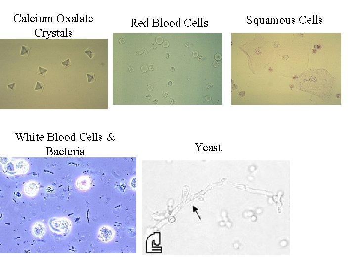 Calcium Oxalate Crystals White Blood Cells & Bacteria Red Blood Cells Yeast Squamous Cells
