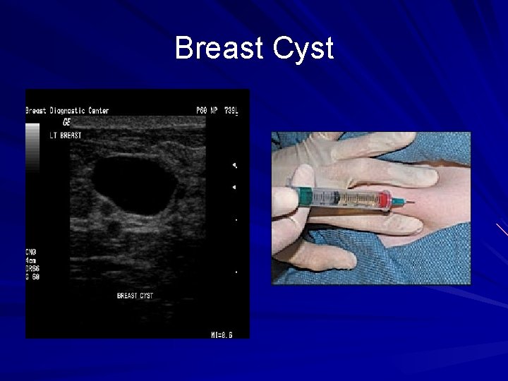 Breast Cyst 